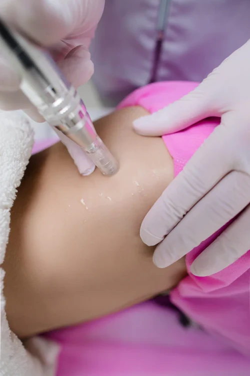 DermaPen тело