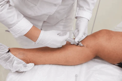 Ozone Therapy for Spider Veins