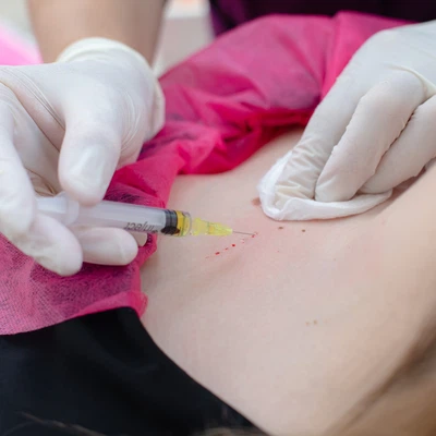 Mezoterapia corporală