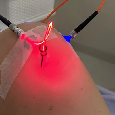 Laser Weber intraarticular